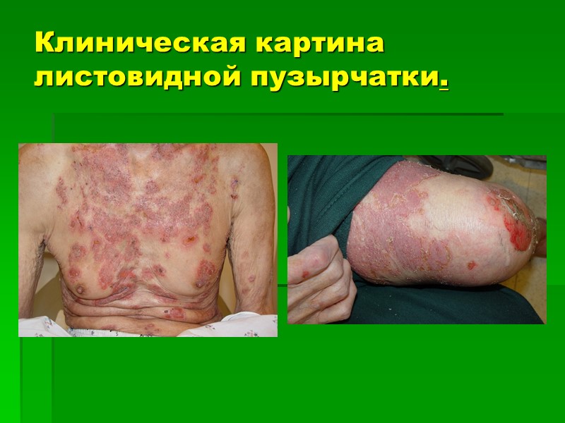 Клиническая картина листовидной пузырчатки.